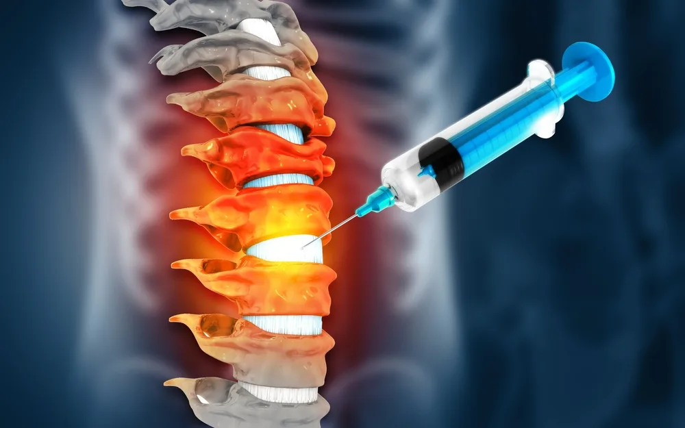 xray image of epidural injection in millburn nj