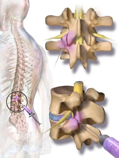 X-ray image of facet joint injections in Millburn NJ