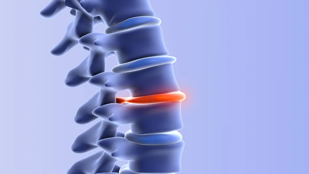 X-ray image of a Herniated Disk