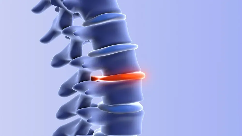 X-ray of a spine showing facet joint arthritis