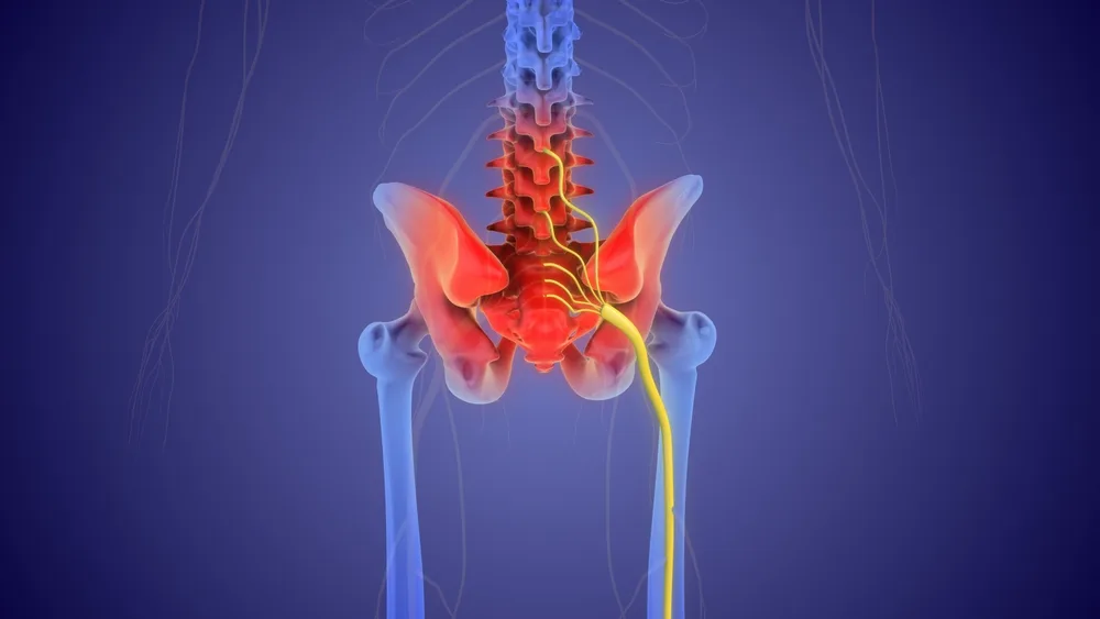 xray image of sciatica pain