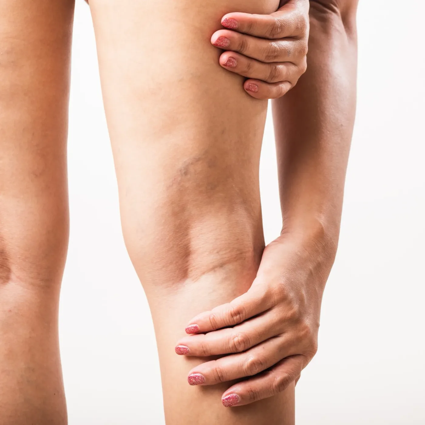 Leg with small varicose veins suitable for sclerotherapy