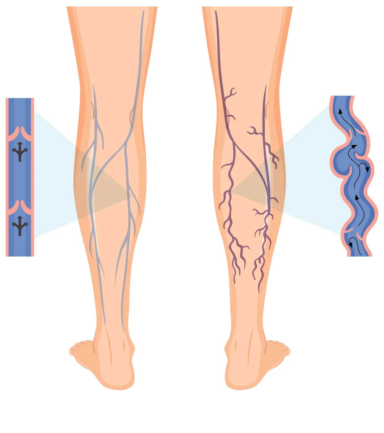 Spider veins on a leg treated with sclerotherapy