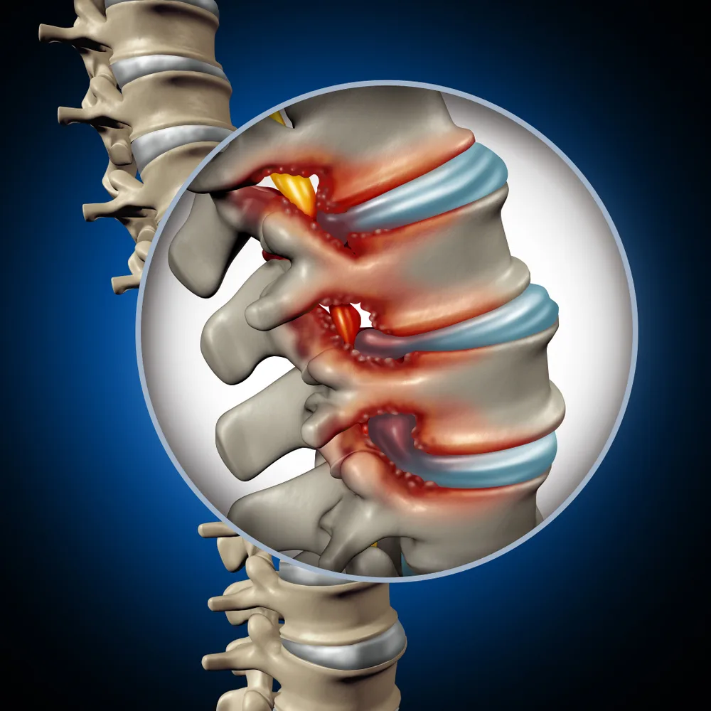x-ray image of spinal stenosis