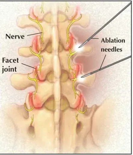 Overview of a spine