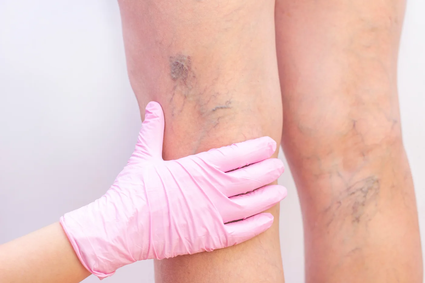 close view of varicose veins on a person's lower leg
