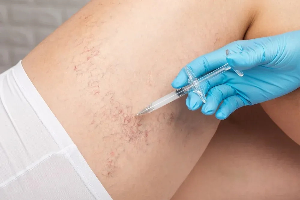 Sclerotherapy-Safe-and-Effective-Treatment-for-Varicose-Veins.jpg