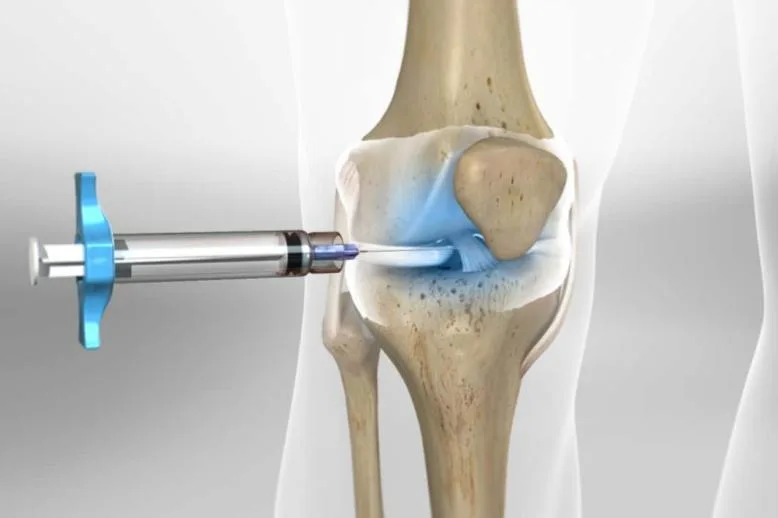 Viscosupplement gel injection for knee osteoarthritis